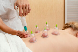Cupping for Weight Loss